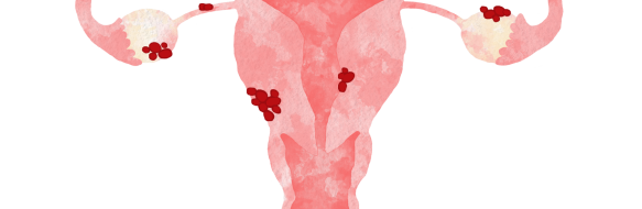 Endometrios