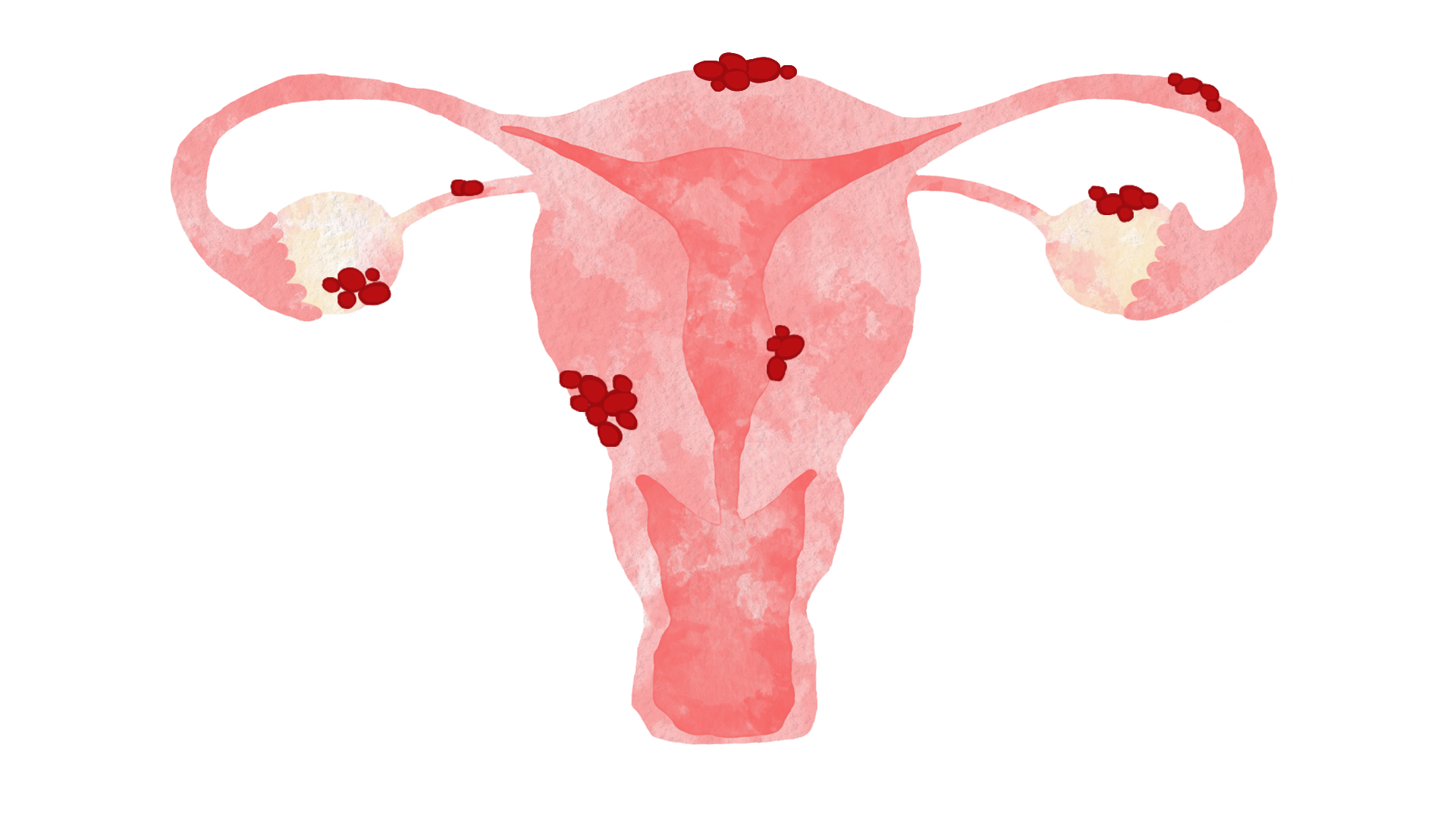 Endometrios